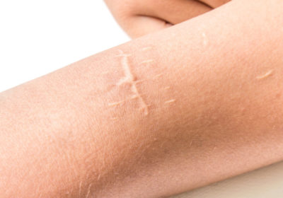 Comment cicatriser rapidement une plaie ?